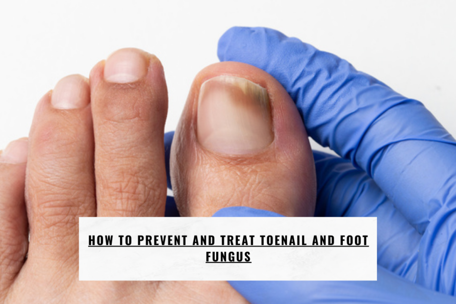 How to Prevent and Treat Toenail and Foot Fungus